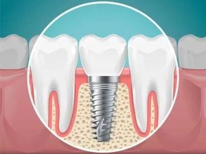Dental implant in Nashik