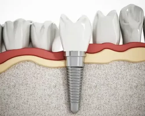 free dental implants in India